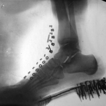 Këmba e Teslës, imazh me rreze X. Eksperiment nga vetë shkencëtari.